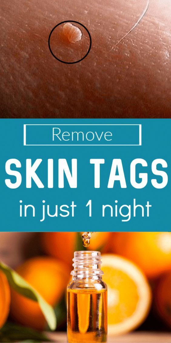 Skin Tag Removal at Home