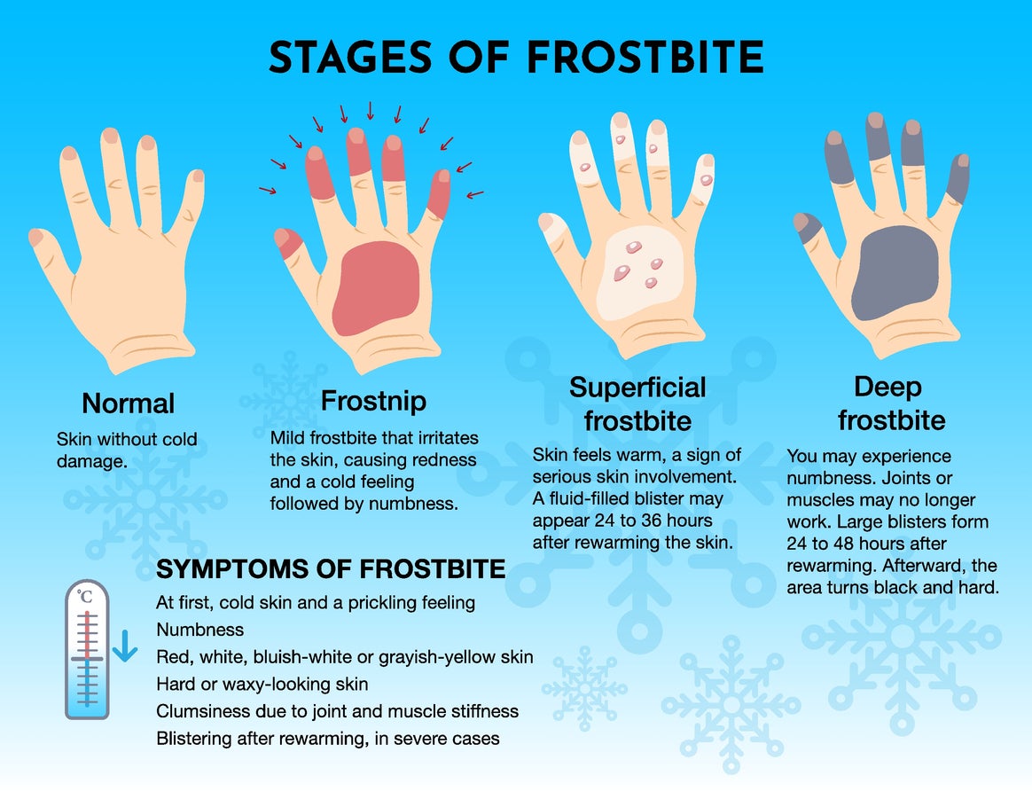 How to Understand Frostbite: Essential Tips for Quick Recovery in 2025